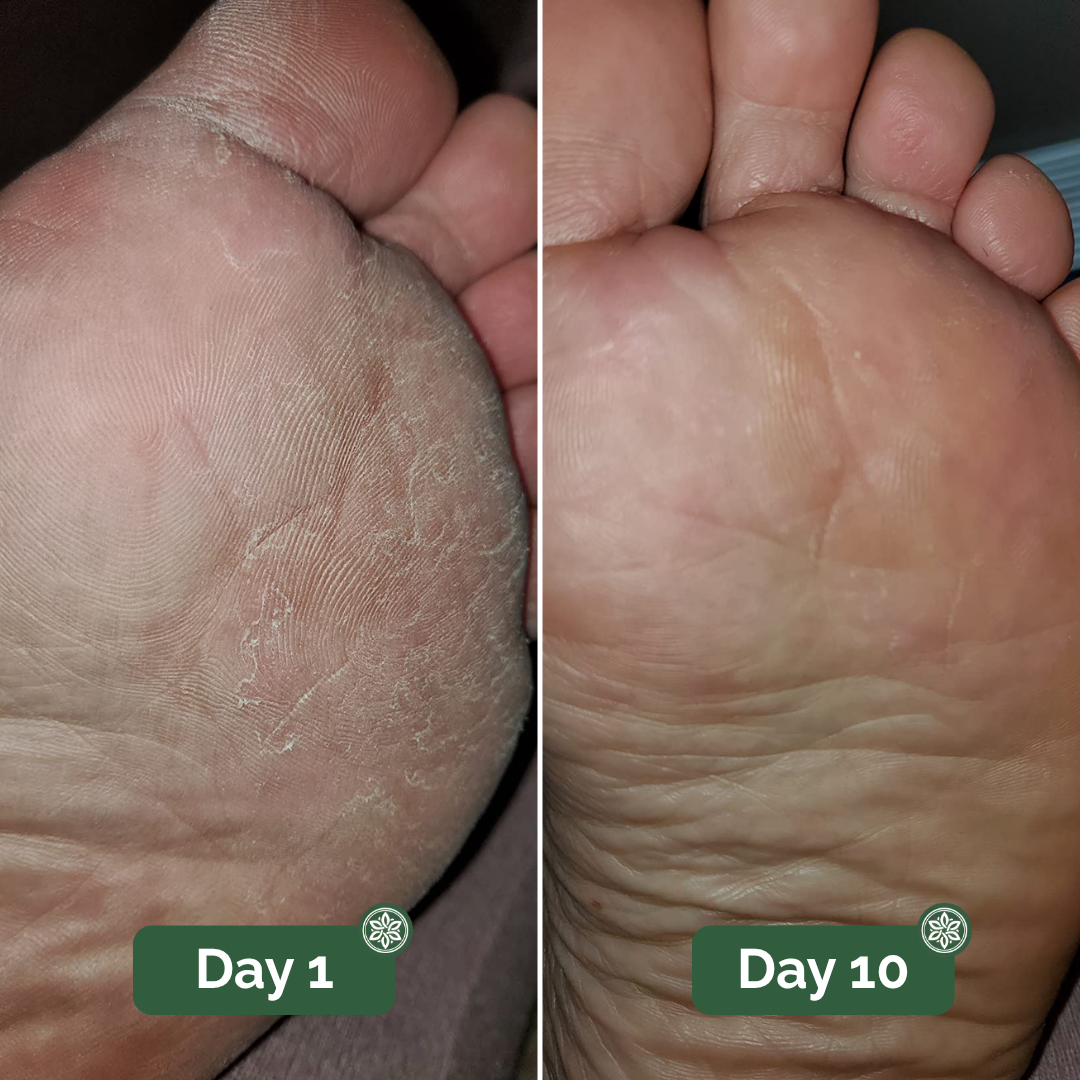 Veloma Antifungal Soap®